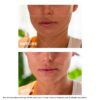 V-Facial Intensive Wrap – entschwellende Gesichtsmaske